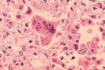 Lưu Ý Về Bệnh Sởi